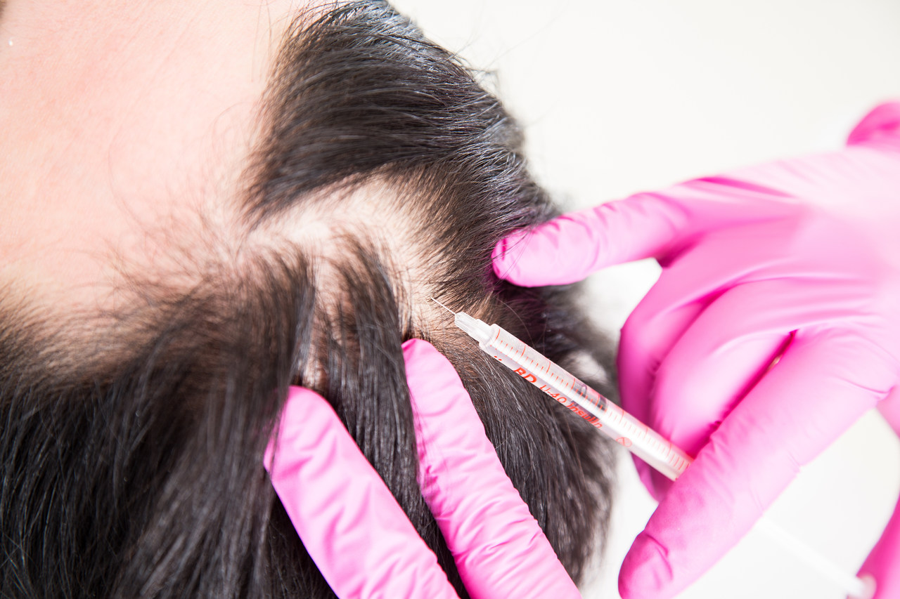 mezoterapia skóry głowy – porost włosów